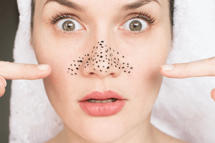 5 Homes Remedies to Get Rid of Blackheads Naturally